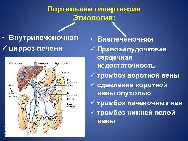 Портальная гипертензия Этиология: • Внутрипеченочная ü цирроз печени • Внепеченочная ü Правожелудочковая сердечная недостаточность