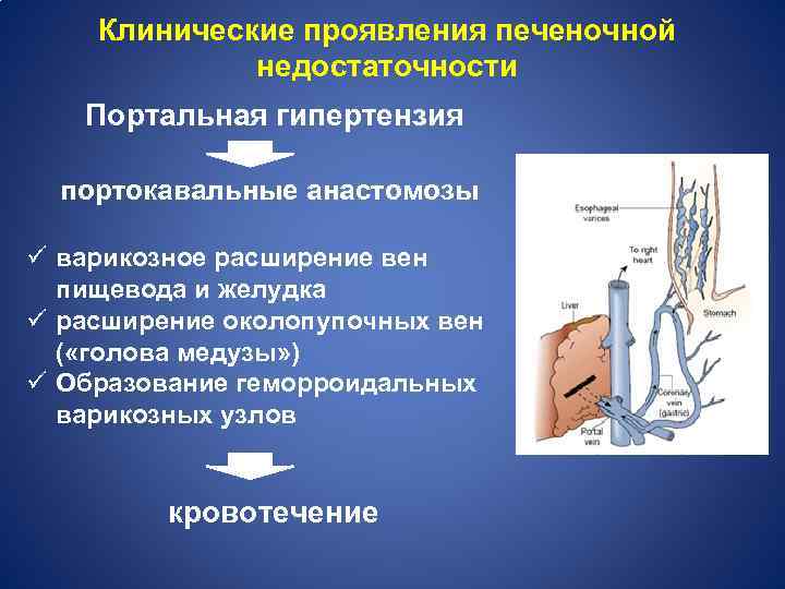Клинические проявления печеночной недостаточности Портальная гипертензия портокавальные анастомозы ü варикозное расширение вен пищевода и