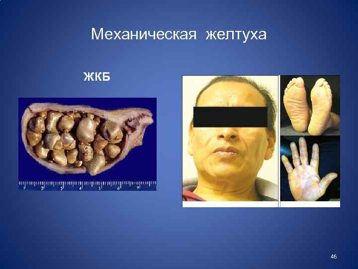 Механическая желтуха ЖКБ 46 