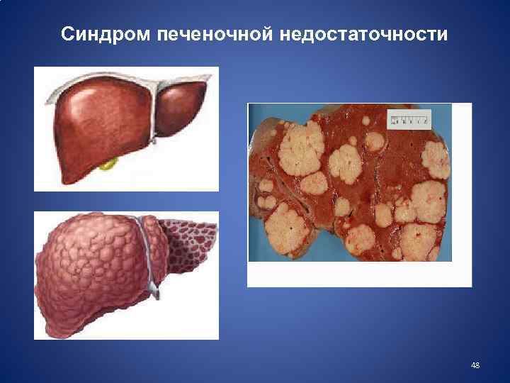Синдром печеночной недостаточности 48 