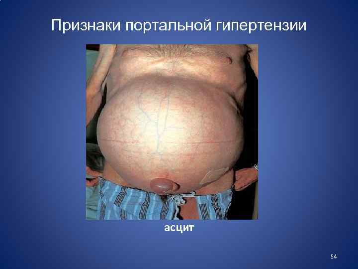 Признаки портальной гипертензии асцит 54 