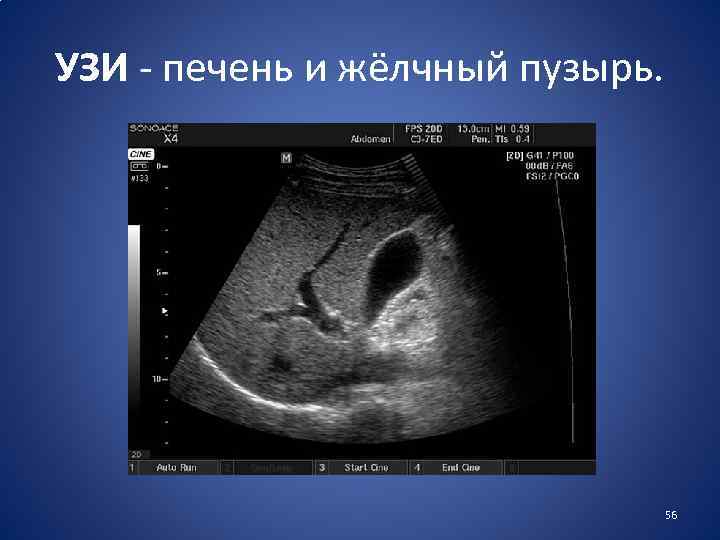УЗИ - печень и жёлчный пузырь. 56 