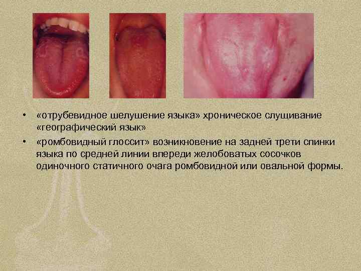  • «отрубевидное шелушение языка» хроническое слущивание «географический язык» • «ромбовидный глоссит» возникновение на