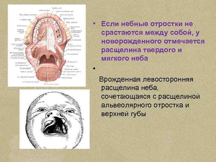  • Если небные отростки не срастаются между собой, у новорожденного отмечается расщелина твердого