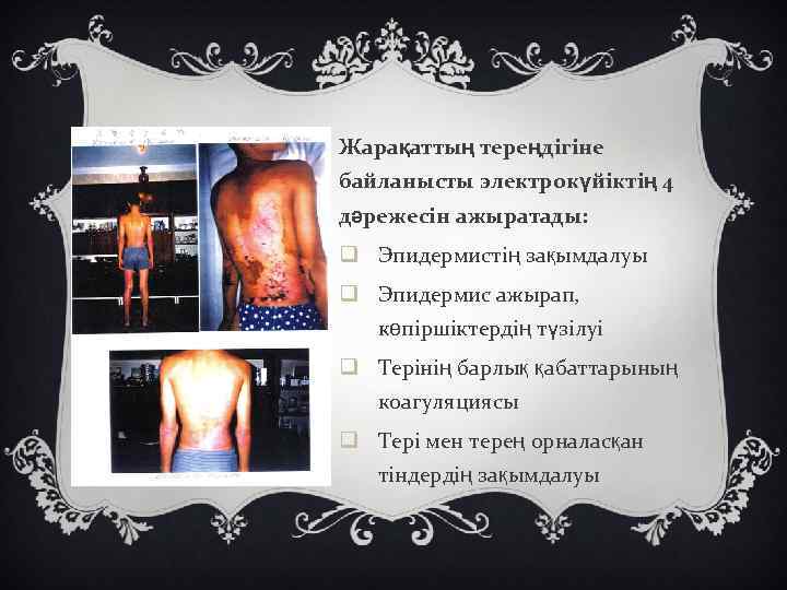 Жарақаттың тереңдігіне байланысты электрокүйіктің 4 дәрежесін ажыратады: q Эпидермистің зақымдалуы q Эпидермис ажырап, көпіршіктердің