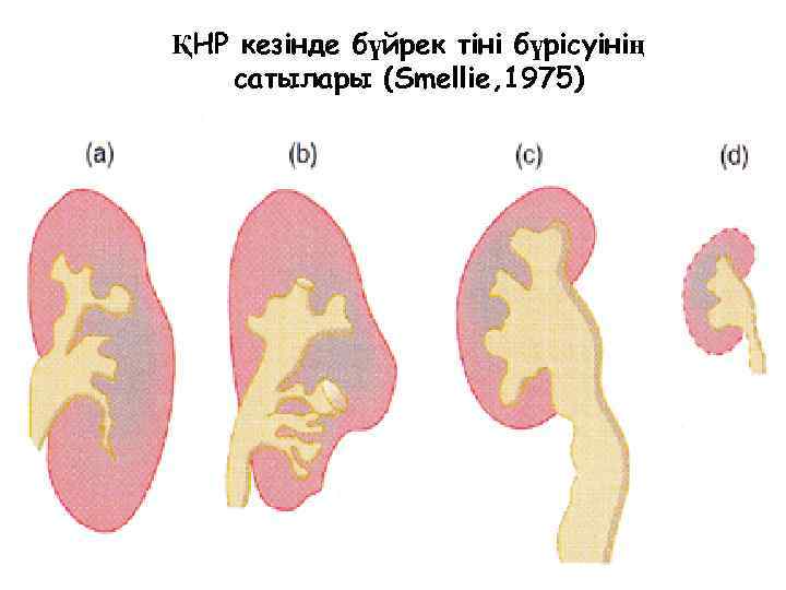 ҚНР кезінде бүйрек тіні бүрісуінің сатылары (Smellie, 1975) 