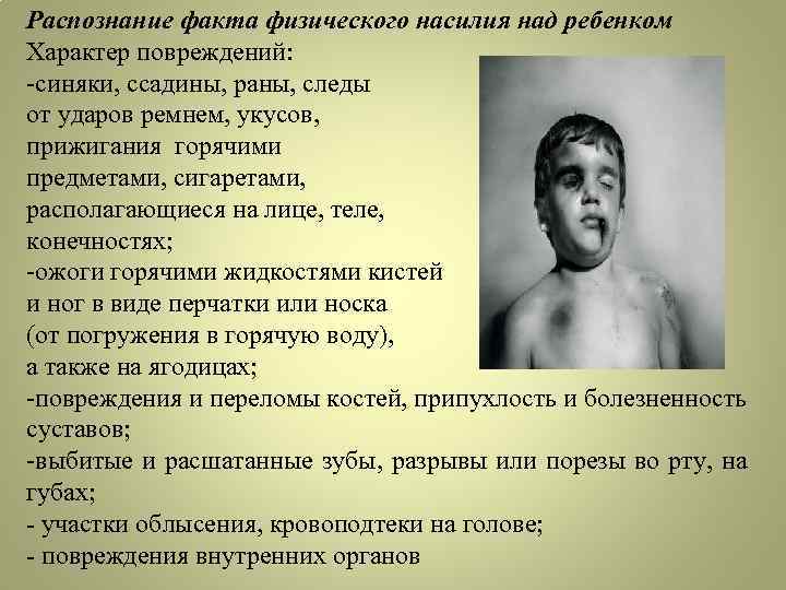 Распознание факта физического насилия над ребенком Характер повреждений: -синяки, ссадины, раны, следы от ударов