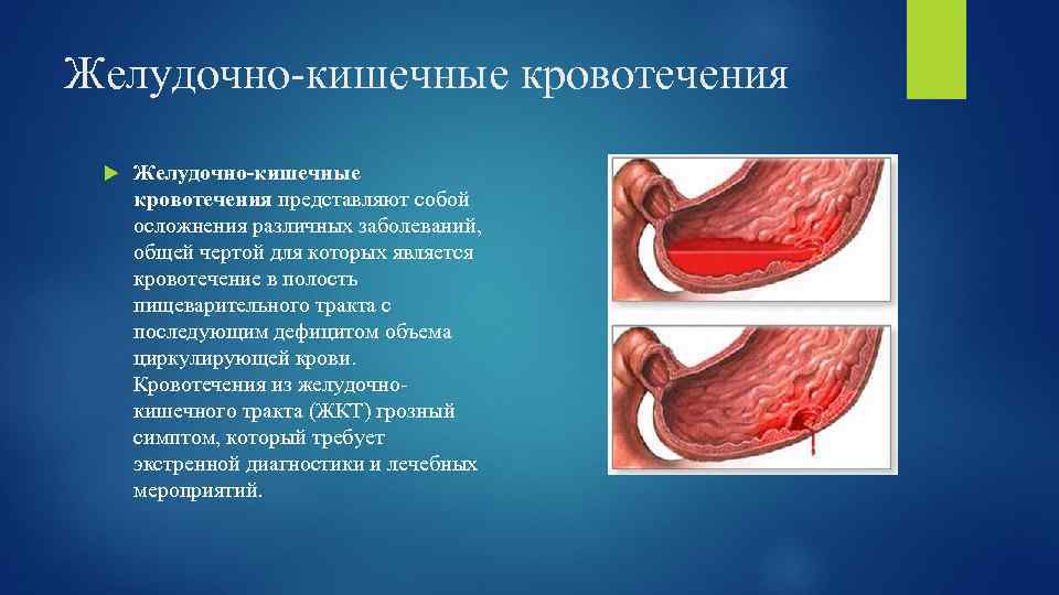 Желудочно-кишечные кровотечения представляют собой осложнения различных заболеваний, общей чертой для которых является кровотечение в