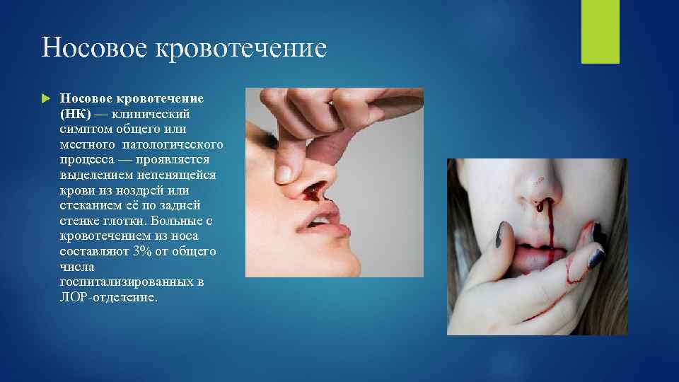 Носовое кровотечение (НК) — клинический симптом общего или местного патологического процесса — проявляется выделением