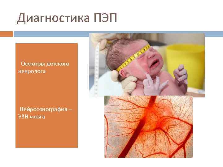 Диагностика ПЭП Осмотры детского невролога • • Нейросонография – УЗИ мозга • 