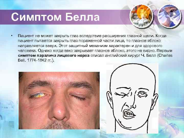 Симптом Белла • Пациент не может закрыть глаз вследствие расширения глазной щели. Когда пациент
