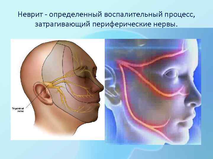 Неврит - определенный воспалительный процесс, затрагивающий периферические нервы. 