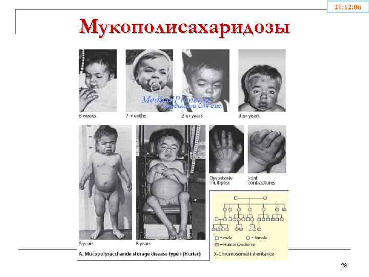 Мукополисахаридозы 28 