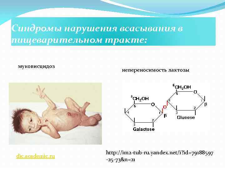Синдромы нарушения всасывания в пищеварительном тракте: муковисцидоз dic. academic. ru непереносимость лактозы http: //im