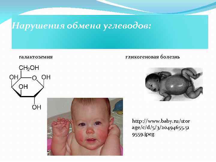 Галактоземия презентация по педиатрии