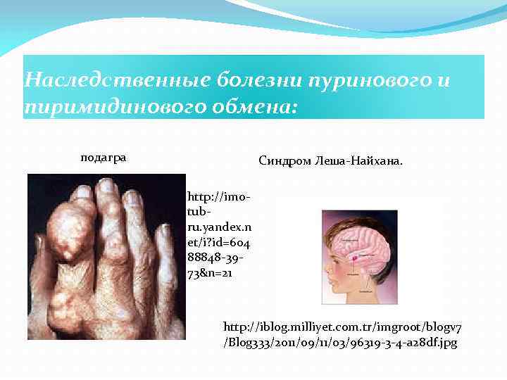 Наследственные болезни пуринового и пиримидинового обмена: подагра Синдром Леша-Найхана. http: //im 0 tubru. yandex.