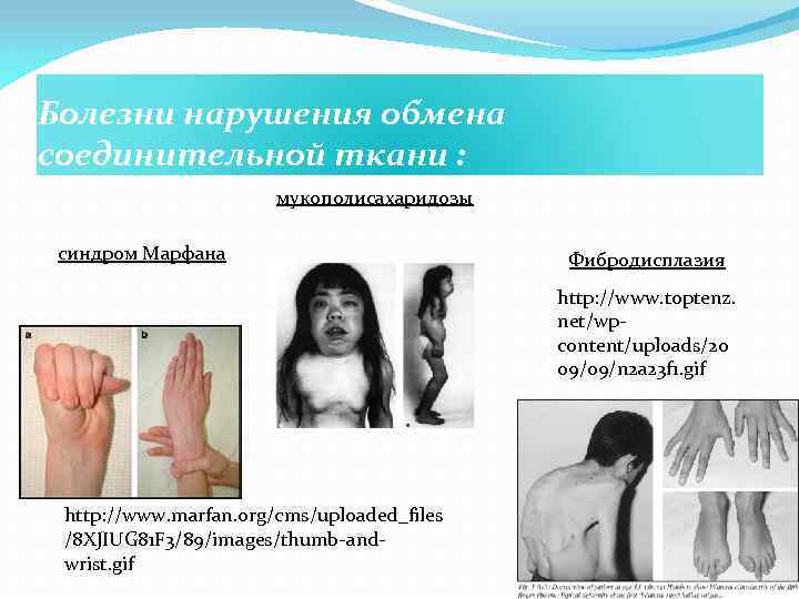 Болезни нарушения обмена соединительной ткани : мукополисахаридозы синдром Марфана Фибродисплазия http: //www. toptenz. net/wpcontent/uploads/20