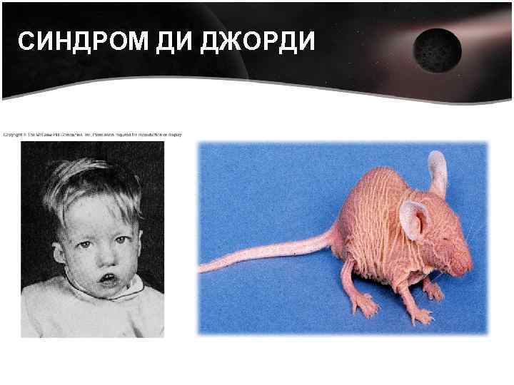 СИНДРОМ ДИ ДЖОРДИ 