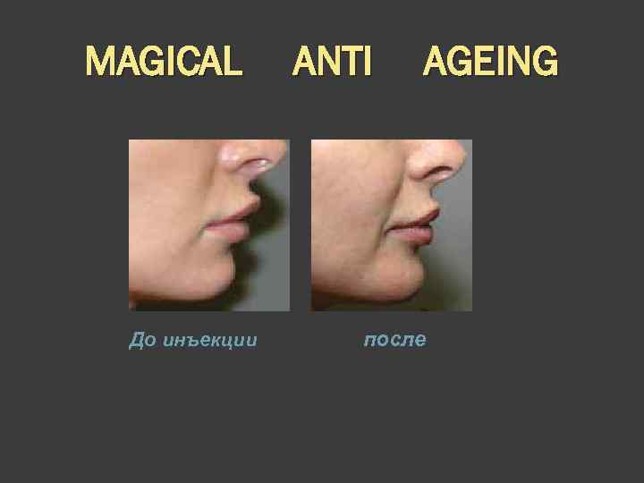 MAGICAL До инъекции ANTI AGEING после 