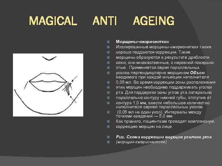 MAGICAL ANTI AGEING Морщины- «марионетки» Изолированные морщины- «марионетки» также хорошо поддаются коррекции. Такие морщины