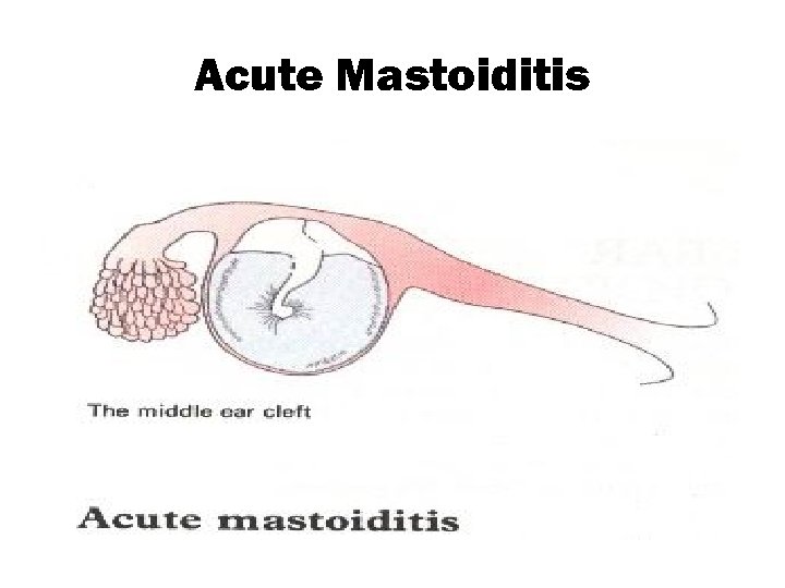 Acute Mastoiditis 