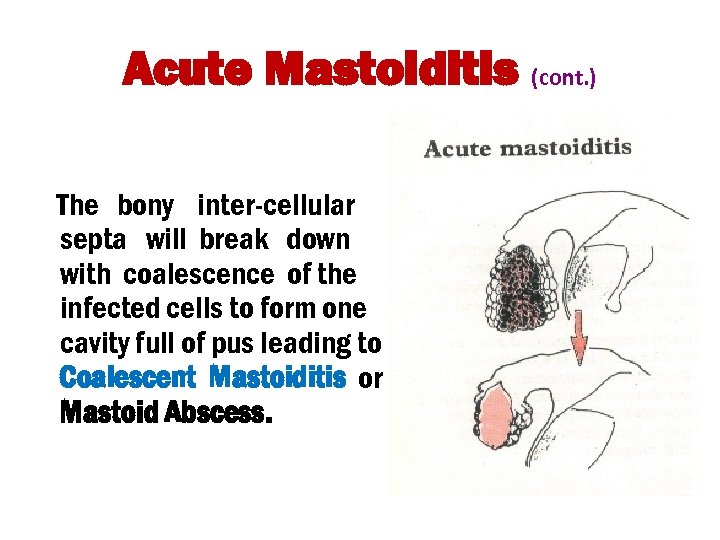 Acute Mastoiditis (cont. ) The bony inter-cellular septa will break down with coalescence of