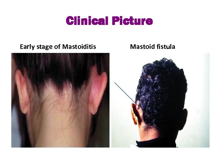 Clinical Picture Early stage of Mastoiditis Mastoid fistula 