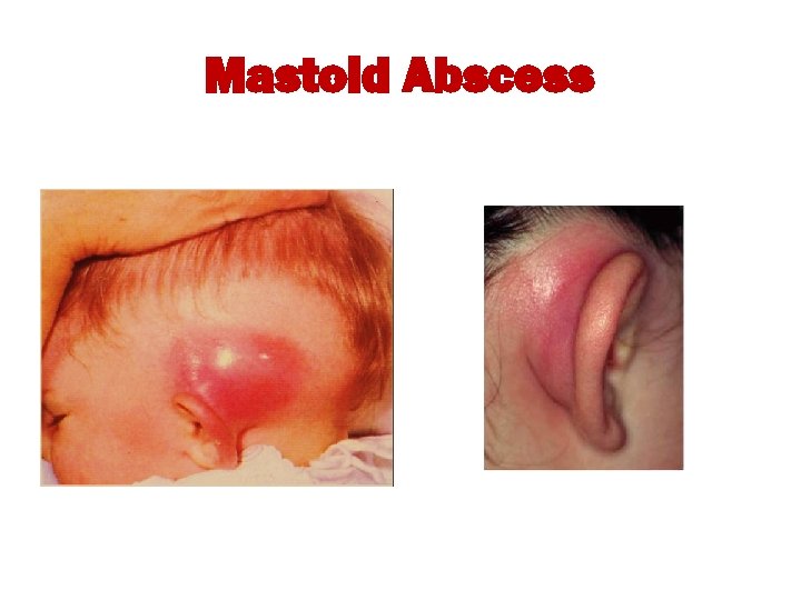 Mastoid Abscess 