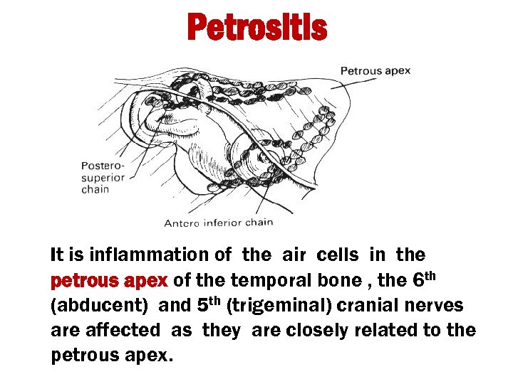 Petrositis It is inflammation of the air cells in the petrous apex of the