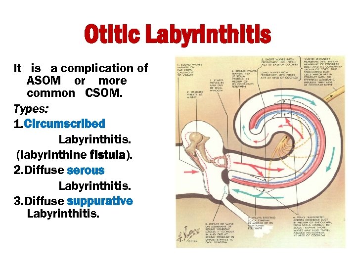 Otitic Labyrinthitis It is a complication of ASOM or more common CSOM. Types: 1.