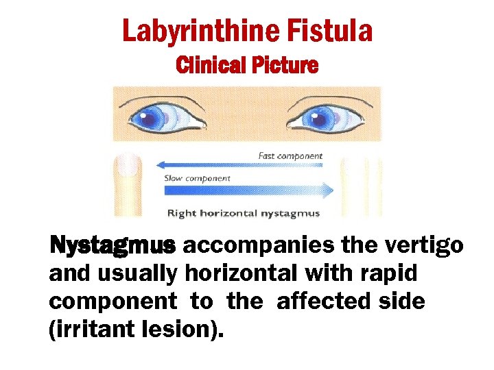 Labyrinthine Fistula Clinical Picture Nystagmus accompanies the vertigo and usually horizontal with rapid component