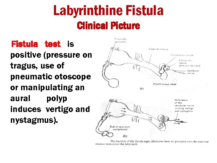 Labyrinthine Fistula Clinical Picture Fistula test is positive (pressure on tragus, use of pneumatic