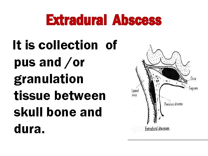 Extradural Abscess It is collection of pus and /or granulation tissue between skull bone