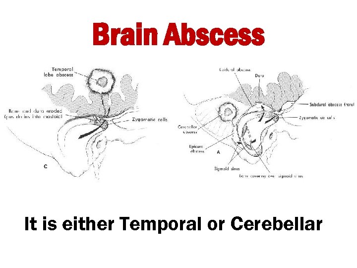 Brain Abscess It is either Temporal or Cerebellar 