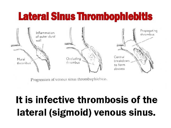 Lateral Sinus Thrombophlebitis It is infective thrombosis of the lateral (sigmoid) venous sinus. 
