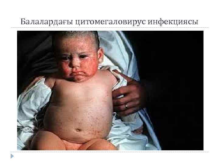 Балалардағы цитомегаловирус инфекциясы 