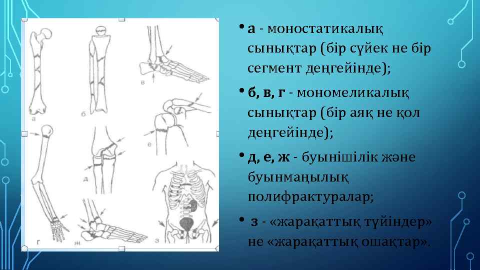  • а - моностатикалық сынықтар (бір сүйек не бір сегмент деңгейінде); • б,