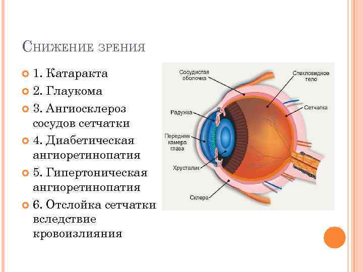 СНИЖЕНИЕ ЗРЕНИЯ 1. Катаракта 2. Глаукома 3. Ангиосклероз сосудов сетчатки 4. Диабетическая ангиоретинопатия 5.