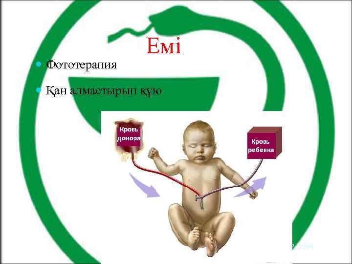  Фототерапия Емі Қан алмастырып құю AAP, 2004 