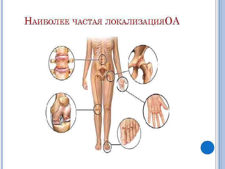 НАИБОЛЕЕ ЧАСТАЯ ЛОКАЛИЗАЦИЯОА 