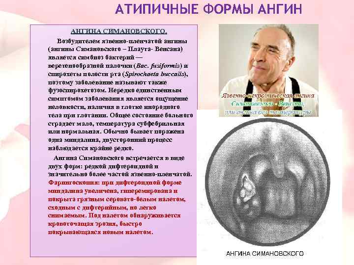 Атипичные формы ангины презентация