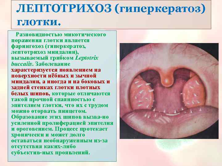 ЛЕПТОТРИХОЗ (гиперкератоз) глотки. Разновидностью микотического поражения глотки является фарингохоз (гиперкератоз, лептотрихоз миндалин), вызываемый грибком