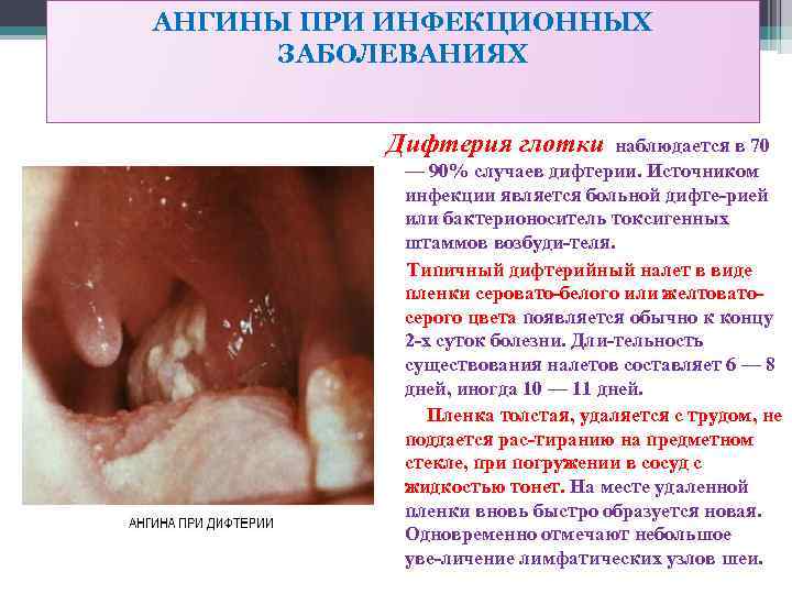 АНГИНЫ ПРИ ИНФЕКЦИОННЫХ ЗАБОЛЕВАНИЯХ Дифтерия глотки наблюдается в 70 — 90% случаев дифтерии. Источником