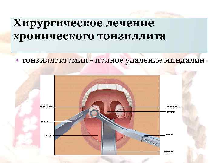 Чем промывать тонзиллит