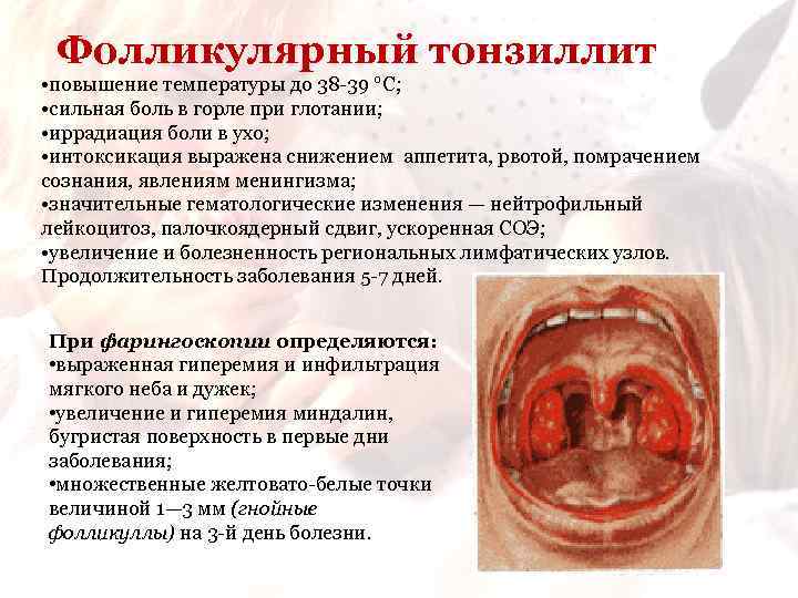 Фолликулярный тонзиллит • повышение температуры до 38 -39 °С; • сильная боль в горле