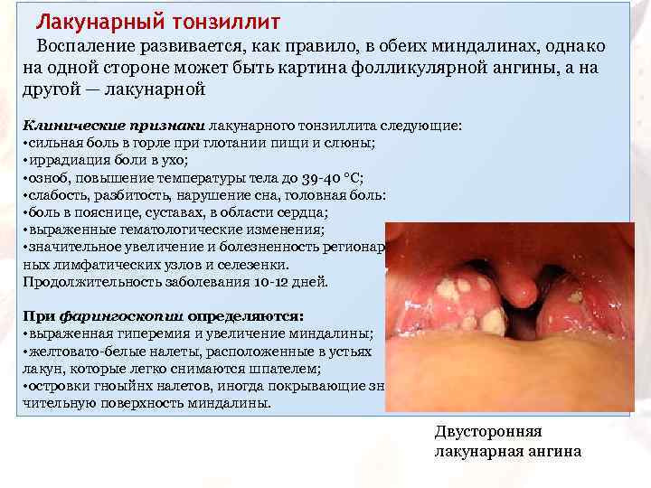 Лакунарный тонзиллит Воспаление развивается, как правило, в обеих миндалинах, однако на одной стороне может