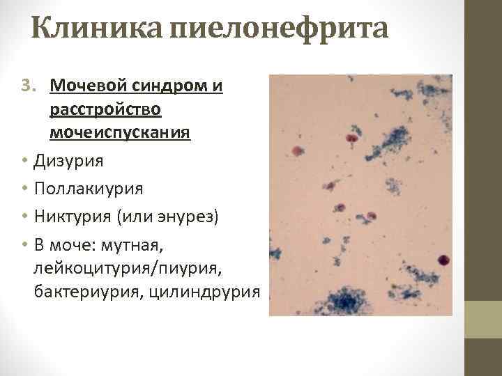 Клиника пиелонефрита 3. Мочевой синдром и расстройство мочеиспускания • Дизурия • Поллакиурия • Никтурия