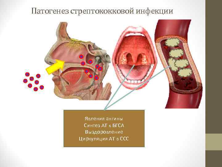 Патогенез стрептококковой инфекции Явления ангины Синтез АТ к БГСА Выздоровление Циркуляция АТ в ССС