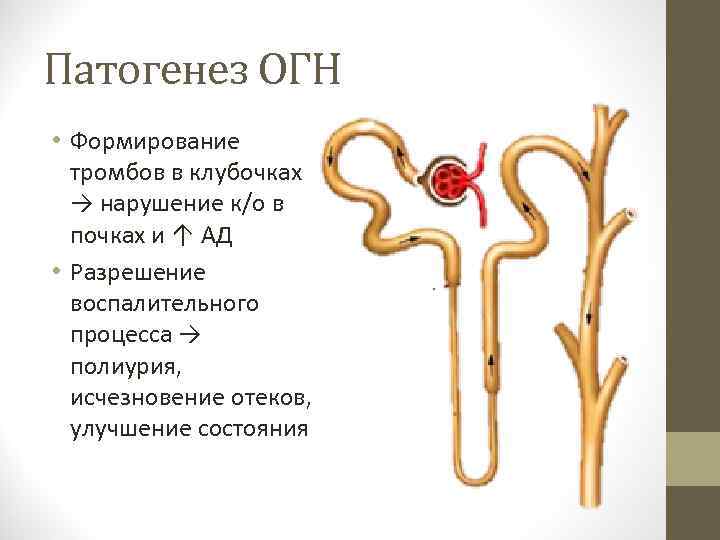 Патогенез ОГН • Формирование тромбов в клубочках → нарушение к/о в почках и ↑