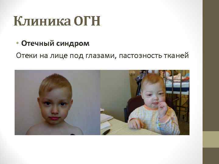 Клиника ОГН • Отечный синдром Отеки на лице под глазами, пастозность тканей 